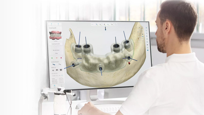 术前 · 云端数据结合AI智能可视种牙方案