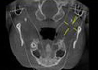 精准定位种植体植入的位置