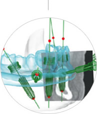 3D种植电脑模拟方案