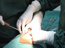 郑院长亲自操刀，实施种植牙手术