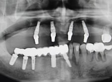 术后CT 手术完全成功
