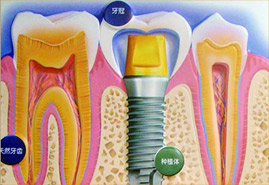 种植体选择标准