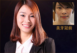 种植牙美学标准